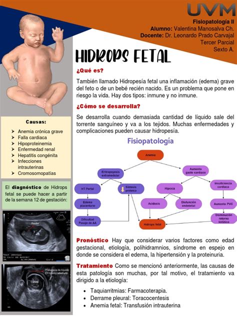 Infografía sobre la hidropesía fetal y sus causas relacionadas con el parvovirus B19.