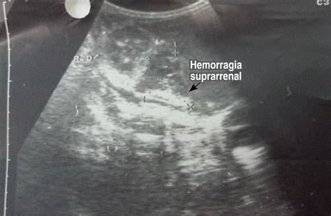 Imagen ecográfica de una hemorragia suprarrenal en el neonato