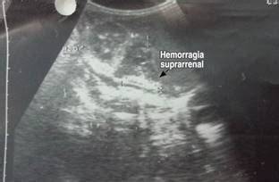 Control evolutivo ecográfico de una hemorragia suprarrenal neonatal