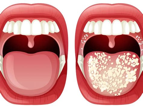 Ilustración de un bebé con candidiasis oral mostrando manchas blancas en la boca