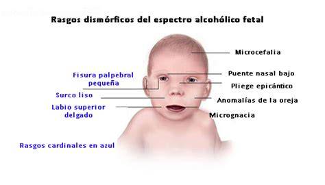 Infografía: Rasgos faciales característicos del Síndrome Alcohólico Fetal