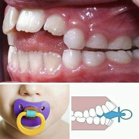 Diagrama: Impacto del uso prolongado del chupete en la mordida abierta y la forma del paladar.