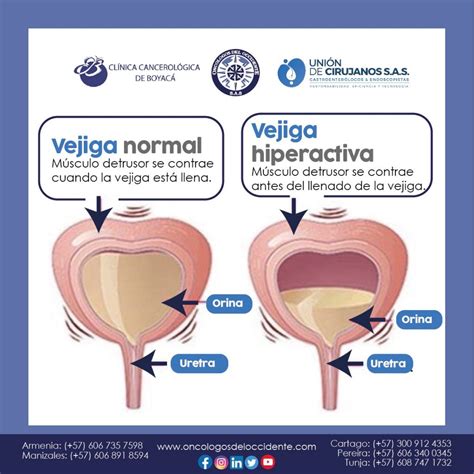 Infografía con consejos prácticos para el manejo de la vejiga en niños con diabetes