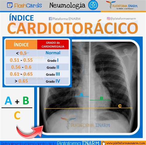 Diagrama mostrando el método de medición del índice cardiotorácico