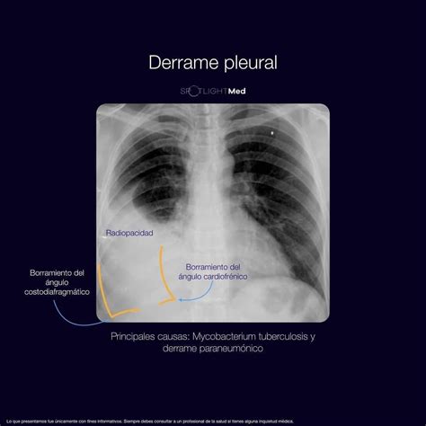 Radiografía de tórax con derrame pleural izquierdo