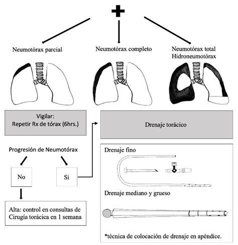 Diagrama de los métodos para calcular el tamaño del neumotórax