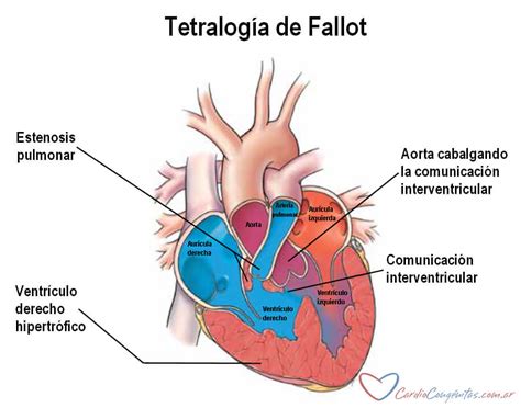 Diagrama de la Tetralogía de Fallot