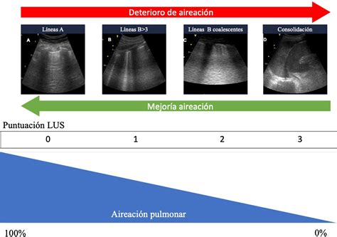 Escala de valoración y puntuación del LUS-score en la ecografía torácica del distrés respiratorio inmediato del pretérmino