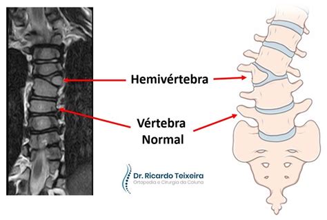 Radiografía o esquema de una columna con hemivértebra o fusión parcial