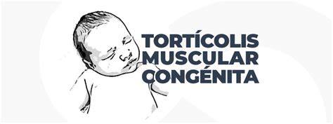 Neonato con tortícolis muscular congénita mostrando inclinación de la cabeza