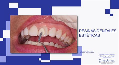 Esquema: Tipos de tratamientos restaurativos en dientes de leche (resina, coronas)