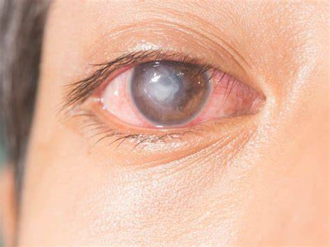 Foto de un ojo con úlcera corneal mostrando enrojecimiento e hipopión