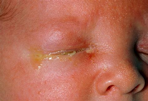 Foto de un recién nacido con síntomas de conjuntivitis neonatal