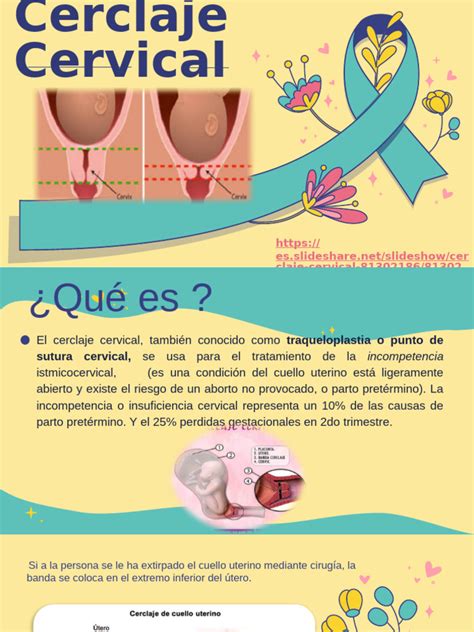 Diagrama de un cerclaje cervical