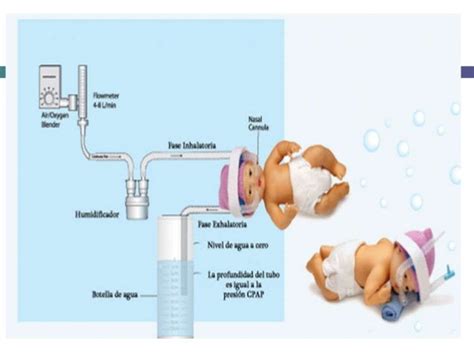 Esquema de un sistema de CPAP nasal para neonatos, mostrando el flujo de gas, el generador de presión y la interfaz nasal.