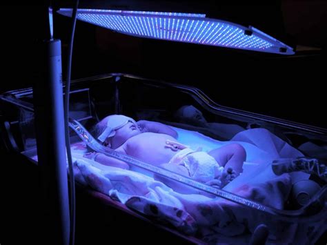Fotografía de un bebé recibiendo fototerapia con los ojos cubiertos