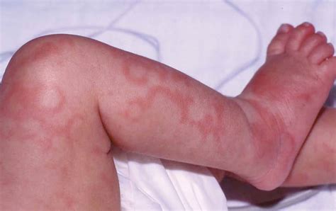 Fotos de lesiones cutáneas típicas del lupus eritematoso neonatal