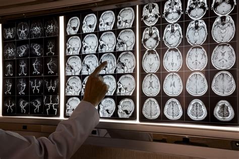 Infografía mostrando resonancia magnética cerebral y punción lumbar