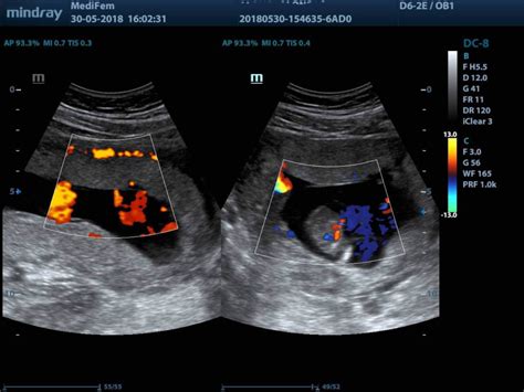 Representación de una ecografía Doppler en 2D mostrando la anatomía fetal temprana y el flujo sanguíneo.