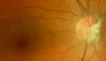 Foto de ojo con mancha de Mittendorf o papila de Bergmeister.