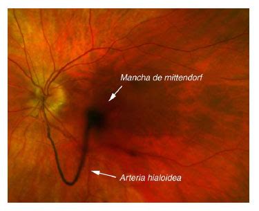 Ecografía ocular mostrando arteria hialoidea persistente y hemorragia vítrea.