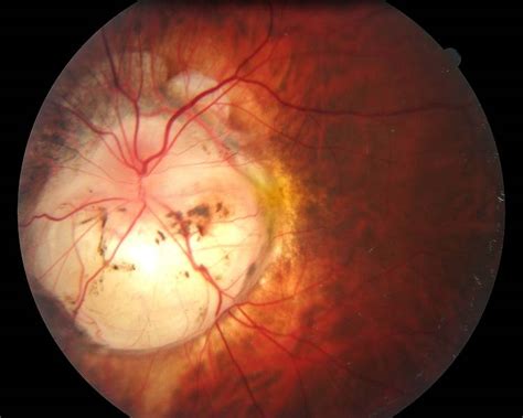 Fotografía de fondo de ojo mostrando el síndrome de Morning Glory con posible remanente de arteria hialoidea.
