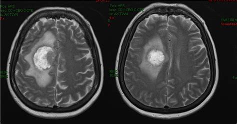 Resonancia magnética de un glioblastoma multiforme con contraste