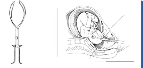 Infografía comparativa de los instrumentos obstétricos: ventosa, fórceps y espátulas