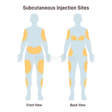 Esquema de las zonas de inyección subcutánea de heparina