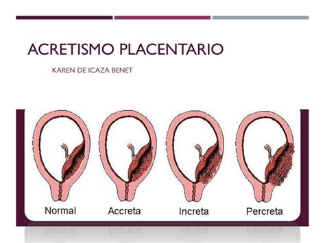 Esquema de los tipos de acretismo placentario (acreta, increta, percreta)