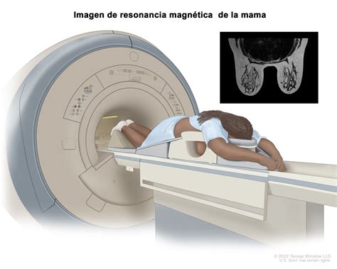 Imagen de resonancia magnética que muestra la invasión de placenta percreta a órganos vecinos