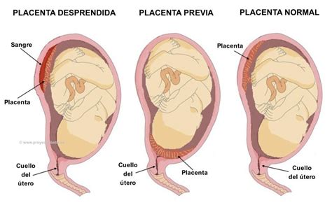 Esquema de la ubicación normal de la placenta y la placenta previa