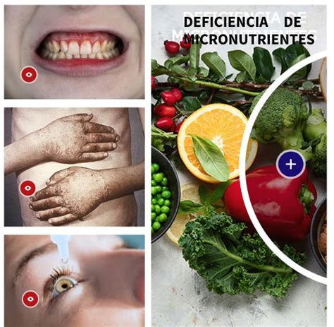 Infografía sobre la deficiencia de micronutrientes en cultivos y sus síntomas