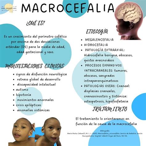 Foto de un bebé con macrocefalia, síntoma de hidrocefalia