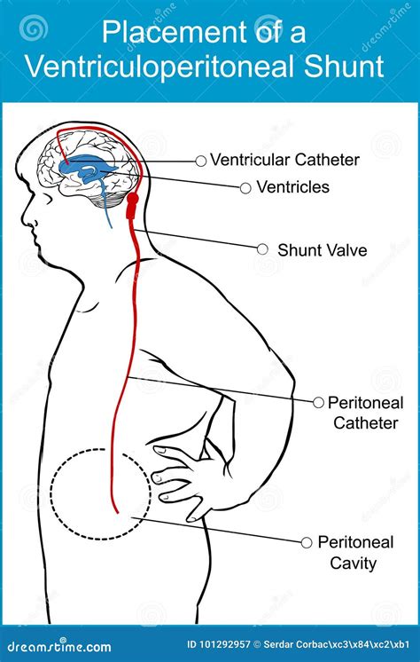 Ilustración de un sistema de derivación ventriculoperitoneal (shunt) implantado en el cerebro y el abdomen