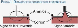 Diagrama que ilustra el signo lambda y el signo T en ecografía para determinar corionicidad.