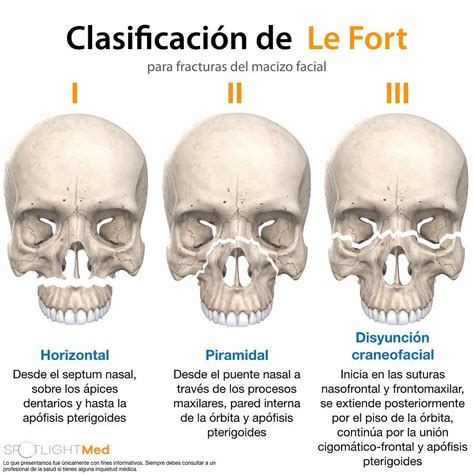 Esquema de la clasificación de fracturas LeFort