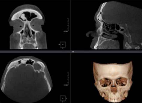 Imagen de una tomografía computarizada facial mostrando una fractura