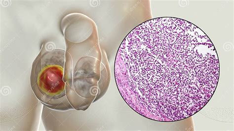 Foto microscópica de un seminoma testicular