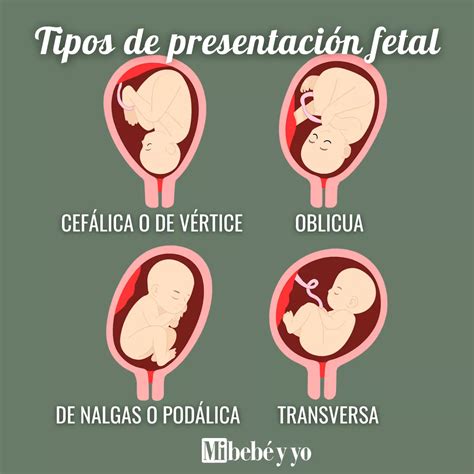 Esquema de las principales presentaciones fetales: cefálica, podálica y transversal