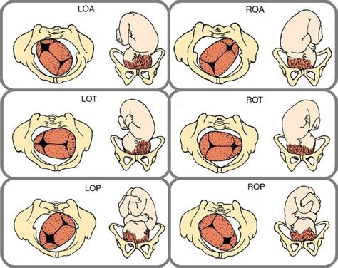 Ilustración de las diferentes presentaciones fetales: occipitoanterior, occipitoposterior, de nalgas y transversa