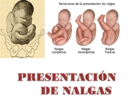 Tipos de presentación de nalgas: franca, completa e incompleta