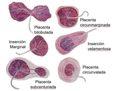 Imágenes o esquemas de placenta bilobulada, placenta previa y corioamnionitis