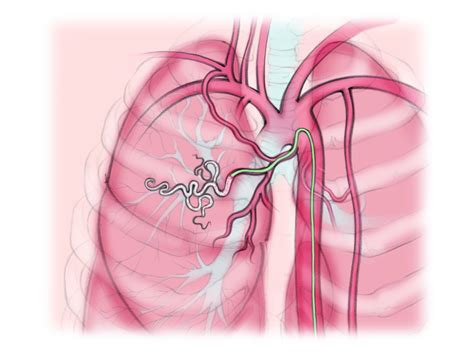 Esquema de la embolización arterial en HPP
