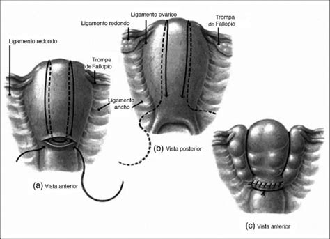 Diagrama de la sutura de B-Lynch