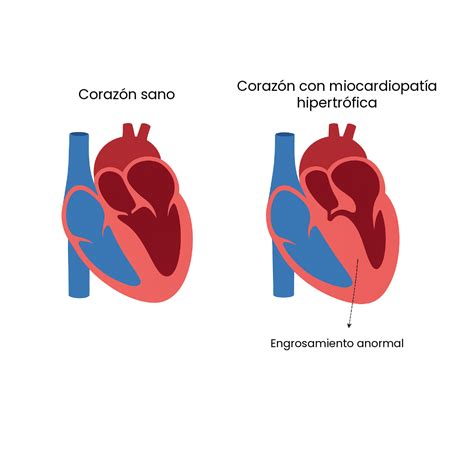 Diagrama de flujo para el cribado y diagnóstico de miocardiopatía hipertrófica fetal en diabetes gestacional