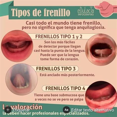 Tabla comparativa visual que ilustra los cuatro tipos de frenillo lingual y su nivel de restricción motriz.