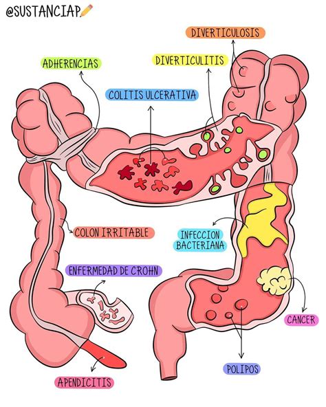 Esquema de la anatomía intestinal de un neonato con foco en el colon y un tapón meconial obstruyéndolo