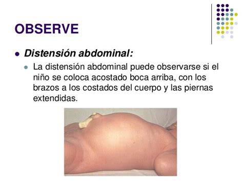 Foto de un neonato con distensión abdominal