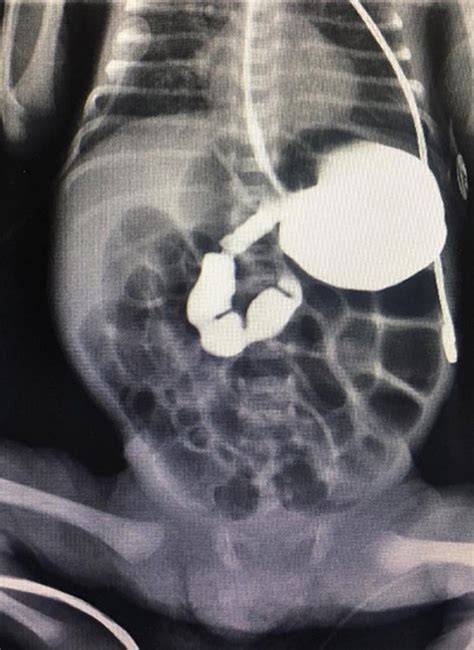 Radiografía abdominal de un neonato mostrando un enema con contraste y un tapón meconial